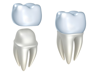 Porcelain Crowns: Medical Dental Solutions for a Variety of Complications