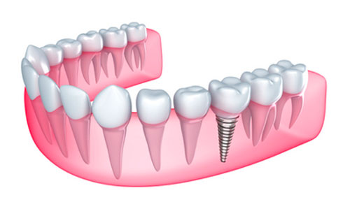 Why Should You Consider Dental Implants?