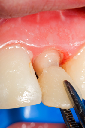 How Dental Veneers Can Improve Your Smile