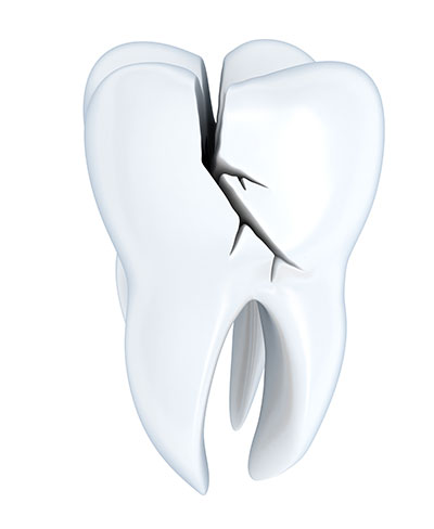 illustration of a cracked tooth