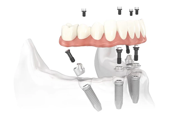 Diagram of All-on-4 Treatment Concept implant bridge placed in the jaw at Singing River Dentistry in Tuscumbia, AL 