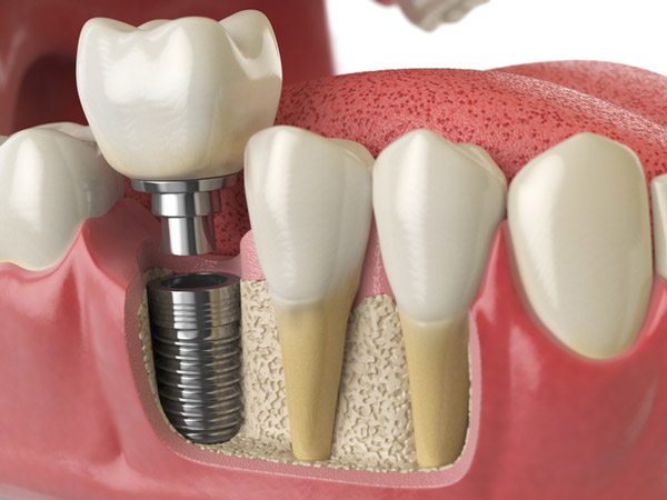 Diagram of dental implant in to jaw bone