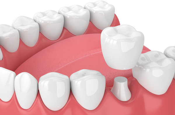 Rendering of a jaw with a dental crown from Singing River Dentistry.