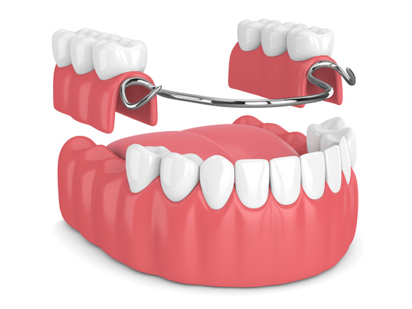 Rendering of removable partial denture at Singing River Dentistry.