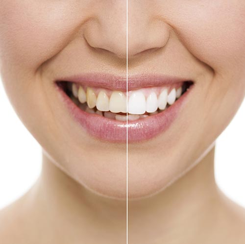 What Causes Teeth Discoloration?