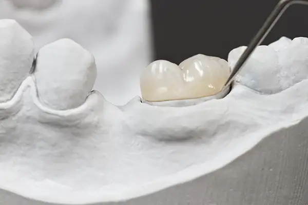 Close-up of a ceramic dental crown being carefully positioned on a dental model with a dental tool, showcasing craftsmanship in restoration.
